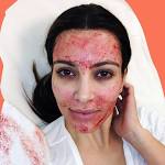 Vampire Facial: Cos’è, Come Funziona e Quali Celebrity lo Hanno Provato