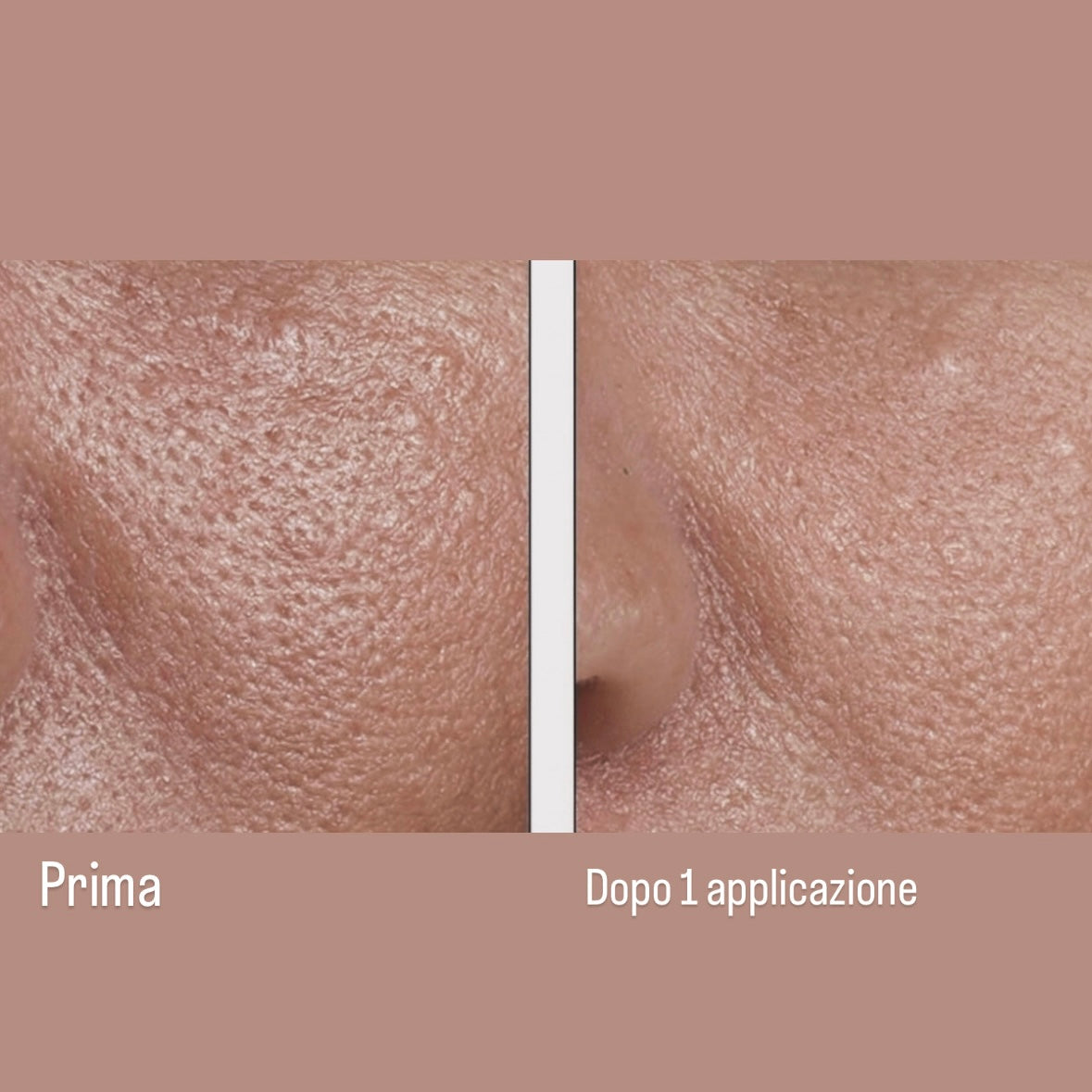 Peeling Olimandelico Con Acido Mandelico