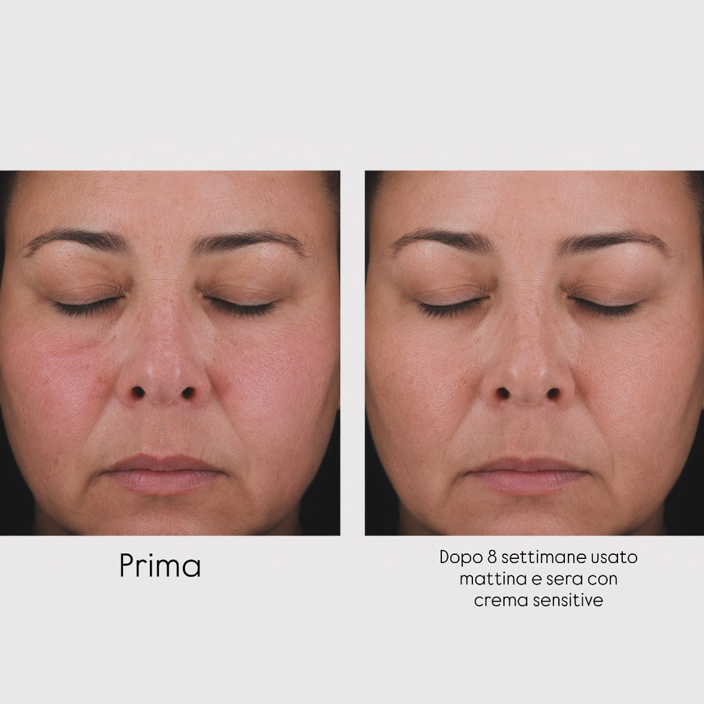 Prima e Dopo di un paziente con rosacea e pelle sensibile