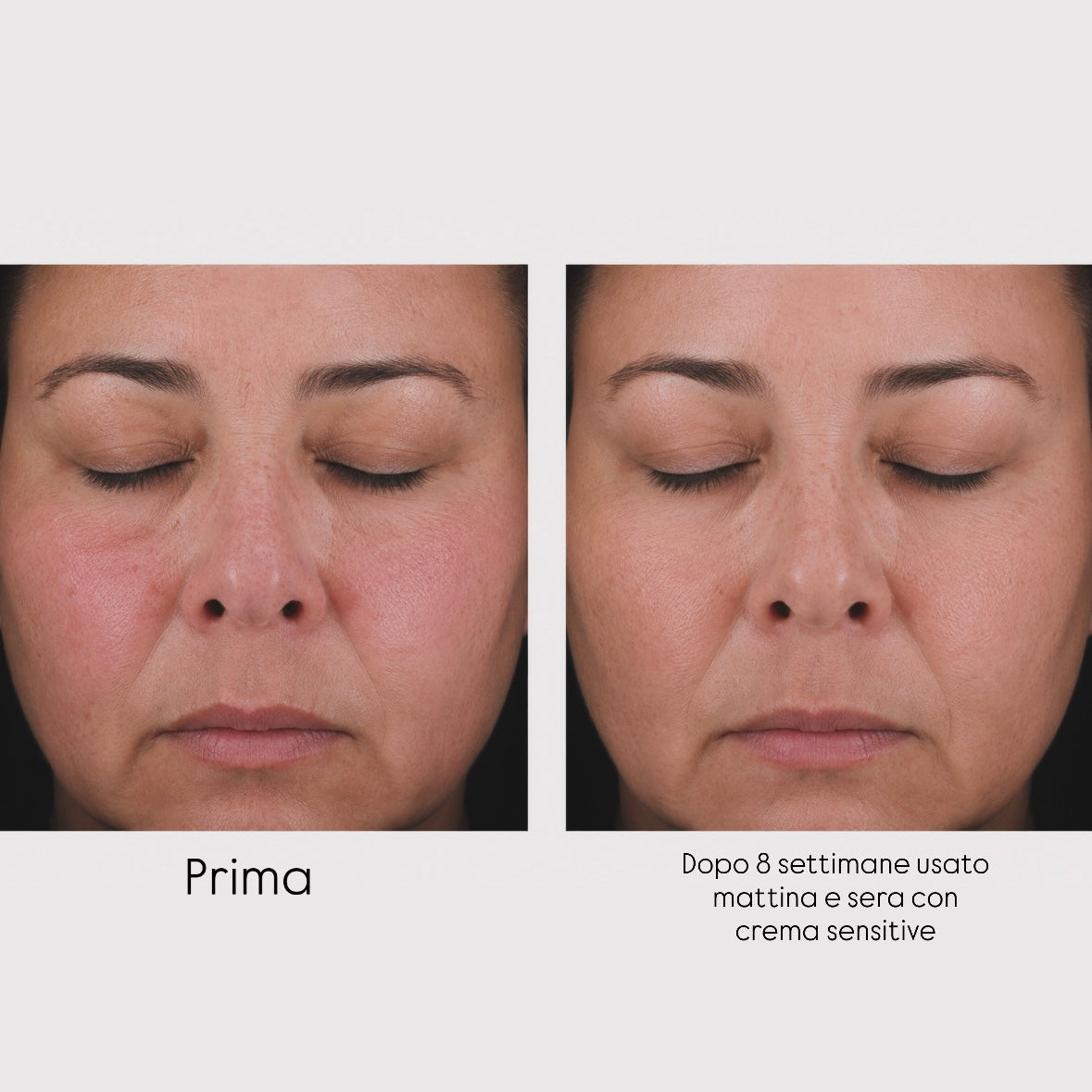 Prima e Dopo di un paziente con rosacea e pelle sensibile