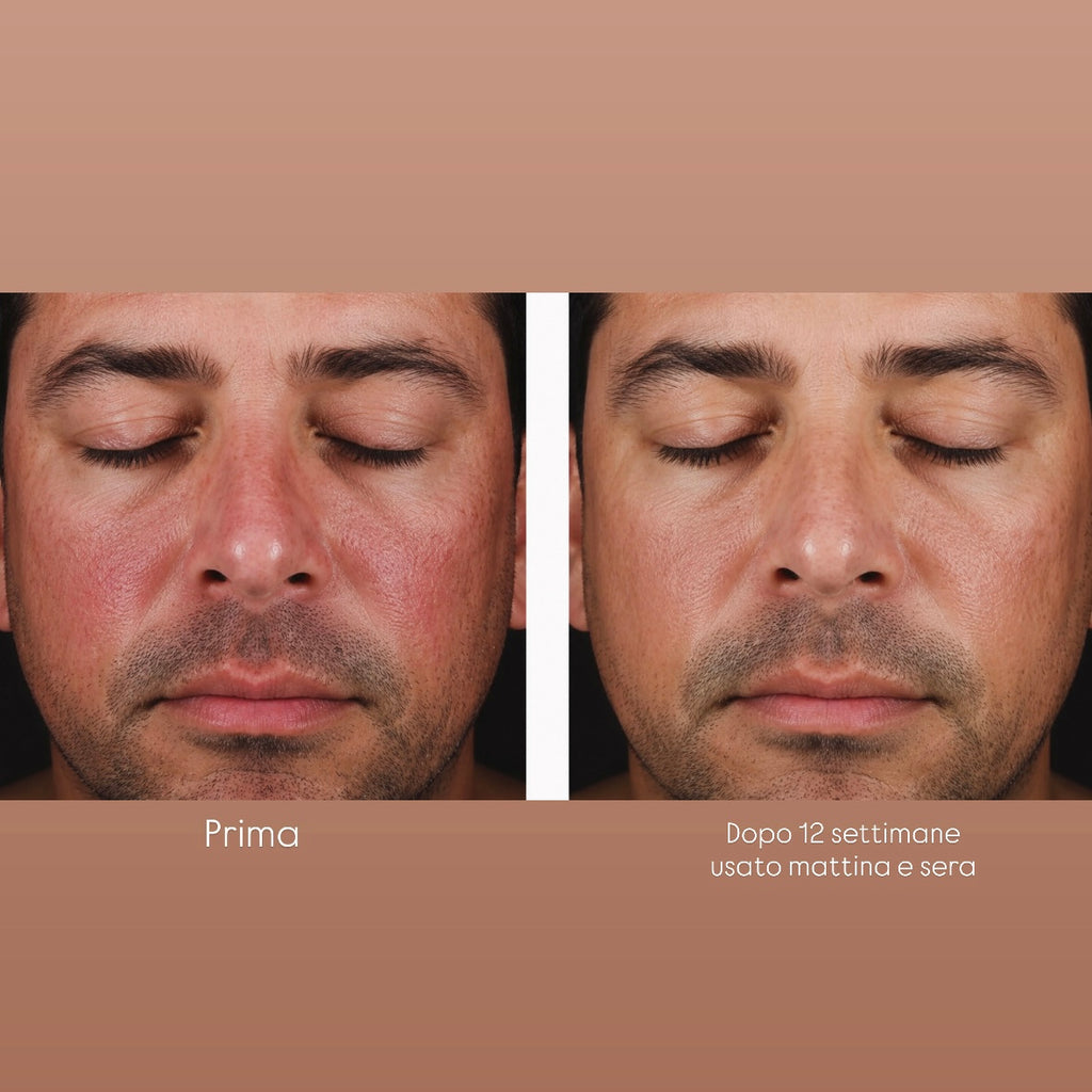 Prima e Dopo di un paziente con rosacea 