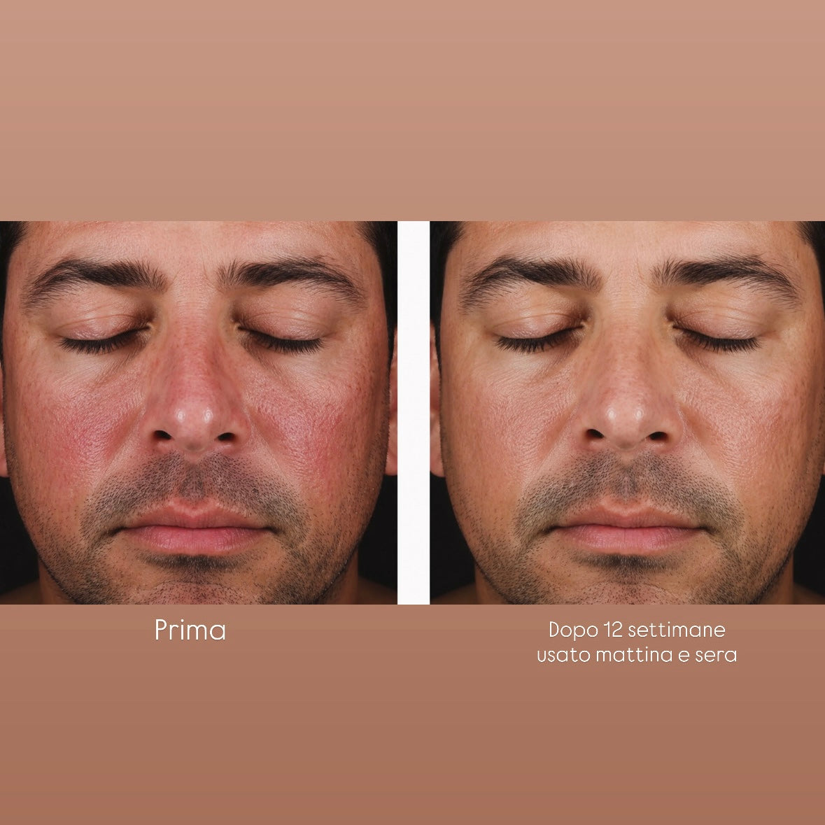 Prima e Dopo di un paziente con rosacea 
