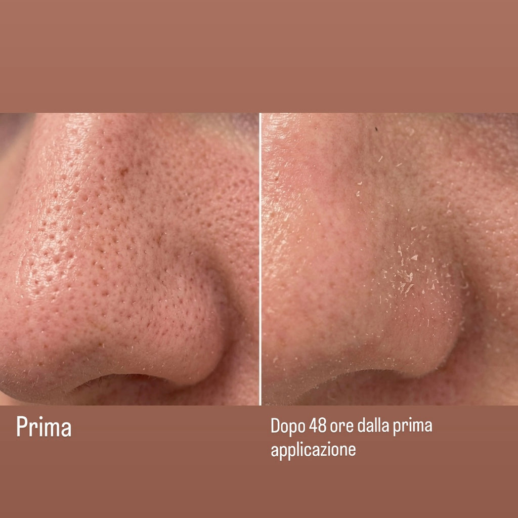 Peeling Acido Salicilico & Mandelico